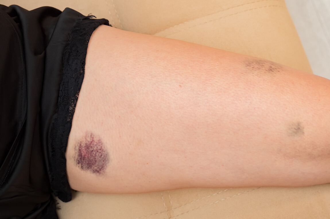 2000 female-leg-with-blue-pink-bruise