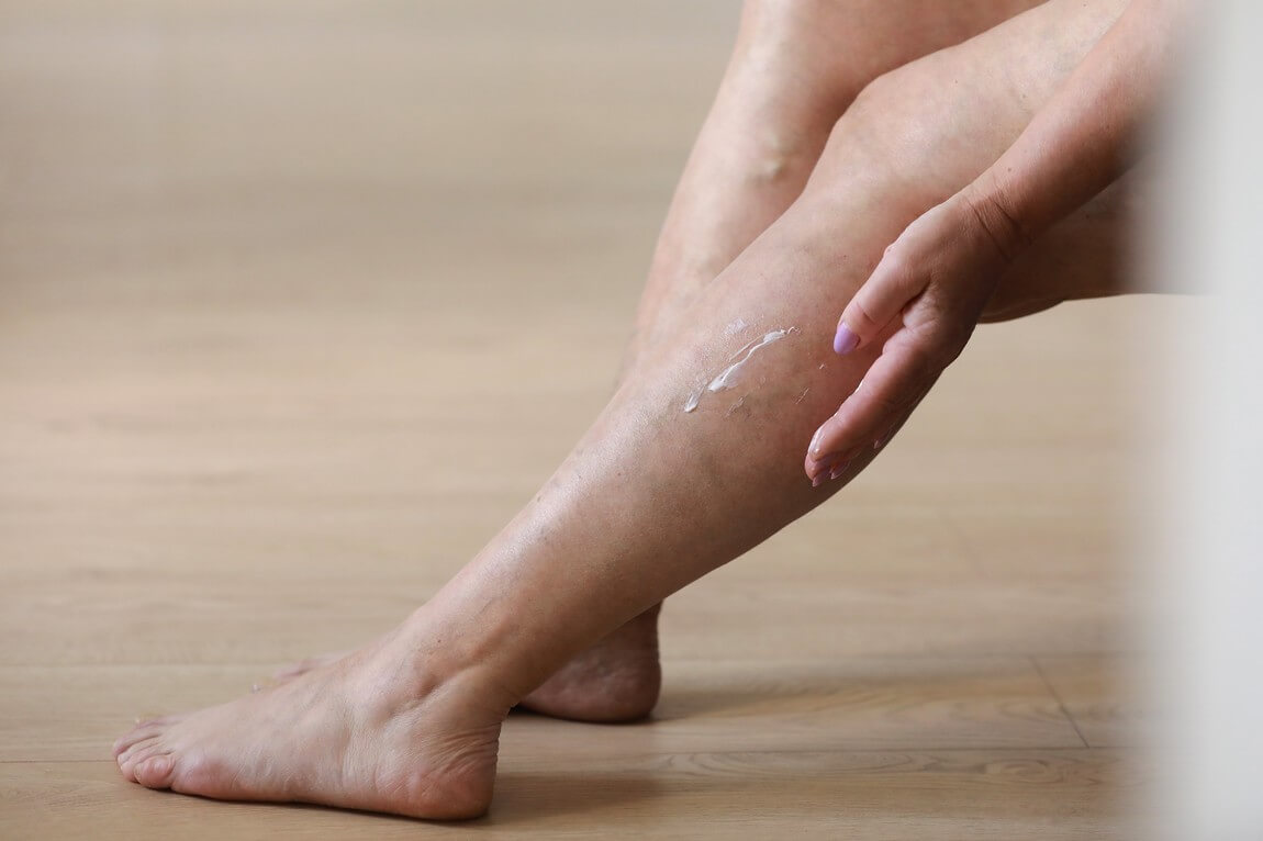 Как снять отек от варикоза: чем мазать ноги?